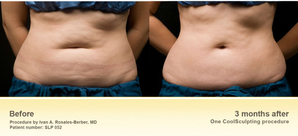 CoolSculpting Flanks (Love Handles) Before & After Photos - Cosmetic - Ark-La-Tex Dermatology & Medical Spa - Louisiana - A Part of the Willis-Knighton Physician Network