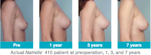 410 breast photos