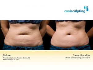 coolsculpting-bna-1