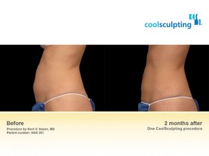 coolsculpting-bna-2