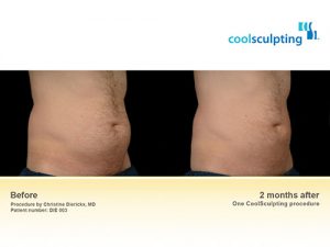 coolsculpting-bna-3