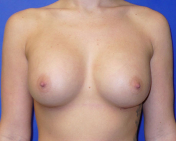 breast-aug-after